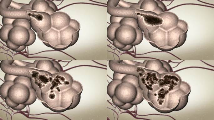 形成痰栓痰液附着在肺泡