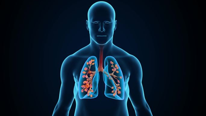 肺部出现肿瘤引起病变