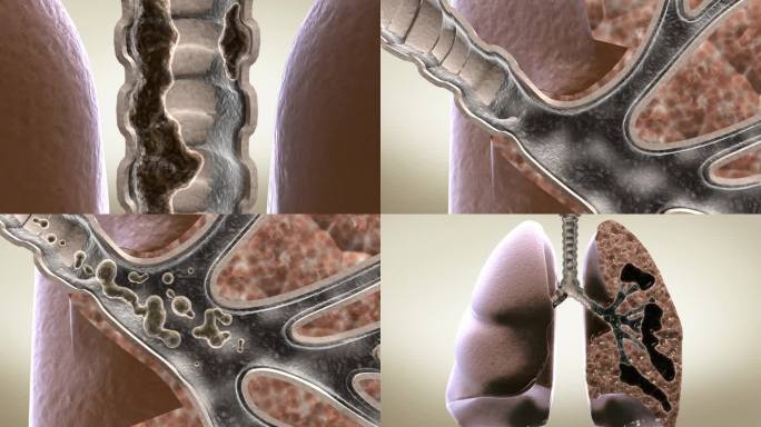 痰栓菌垢附着在气管