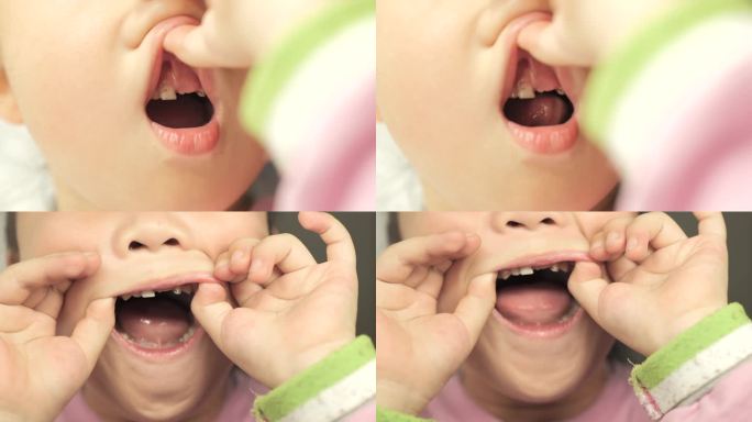 儿童缺牙龋齿
