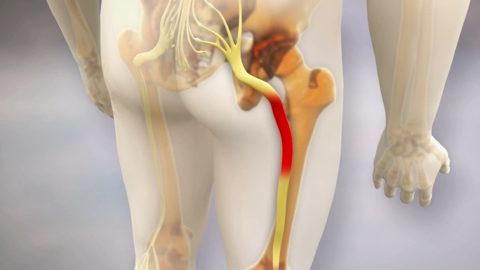 坐骨神经痛视频坐骨神经痛ae素材3D动画