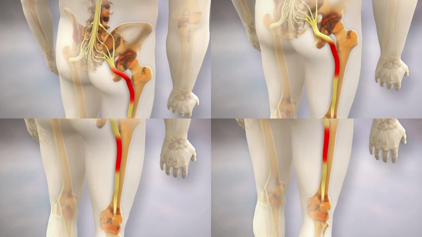 坐骨神经痛视频坐骨神经痛ae素材3D动画