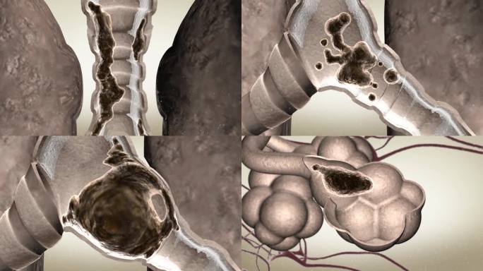 形成痰栓痰液附着在肺部