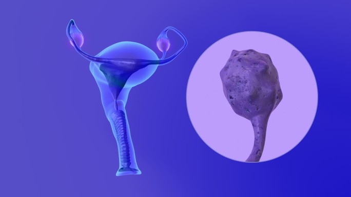多囊卵巢综合征是一种转移到子宫、输卵管或子宫的卵巢癌亚型。