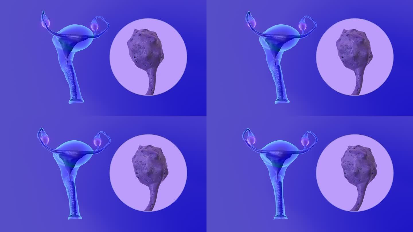 多囊卵巢综合征是一种转移到子宫、输卵管或子宫的卵巢癌亚型。