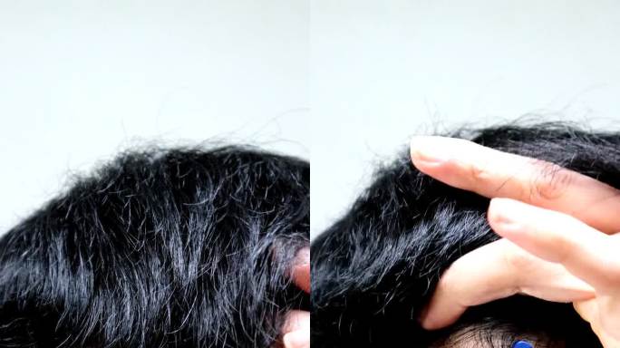 日本男性正遭受头发稀疏的困扰