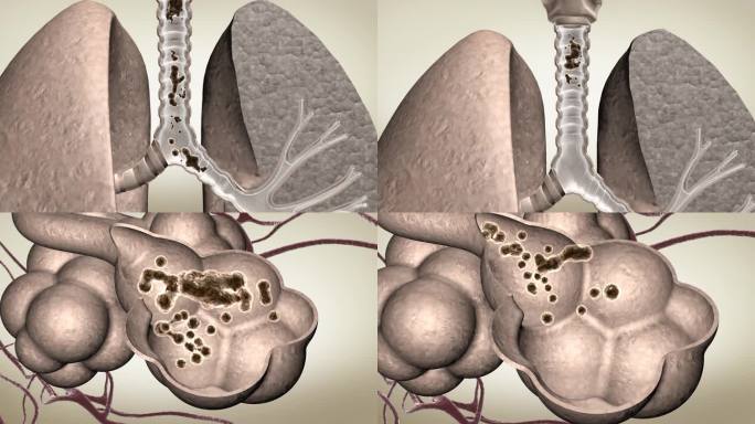 肺部痰栓变清痰清除体外
