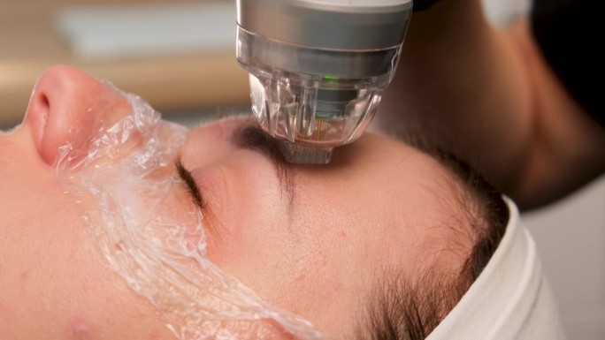 美容诊所眼睑区域射频提升手术的特写。