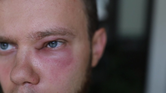 眼睛结膜炎的炎症，男人的一种过敏反应