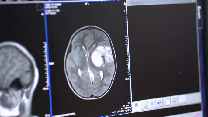 医院核磁检查CT医学影像研究脑部病变手术