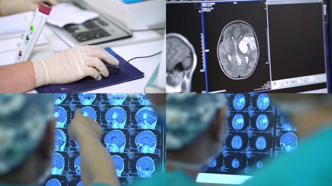 医院核磁检查CT医学影像研究脑部病变手术