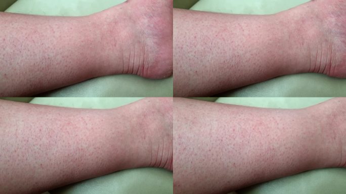皮肤红血疹，登革热症状，蚊子热带病4k