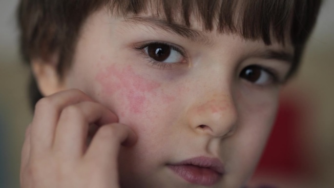 男孩皮肤干红，还抓挠脸。儿童抓伤特应性皮肤。儿童身体和面部的皮炎、素质低下、过敏。刺激和瘙痒。男孩皮