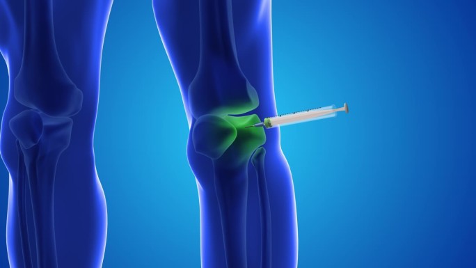一个动画显示干细胞被注射到人类的膝盖