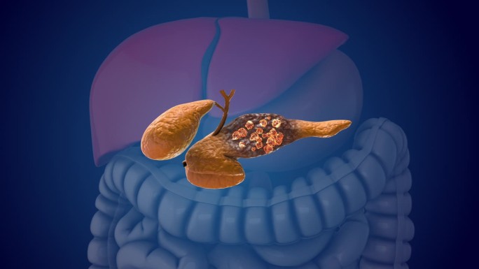 胰腺损伤和癌细胞的生长