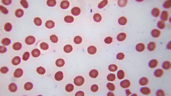 显微镜下的红细胞和白细胞。总部的视频。科学课。在固定的和染色的样品上对人体血液成分的检验。生化实验室