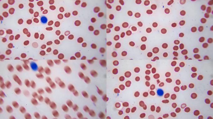 显微镜下的红细胞和白细胞。总部的视频。科学课。在固定的和染色的样品上对人体血液成分的检验。生化实验室