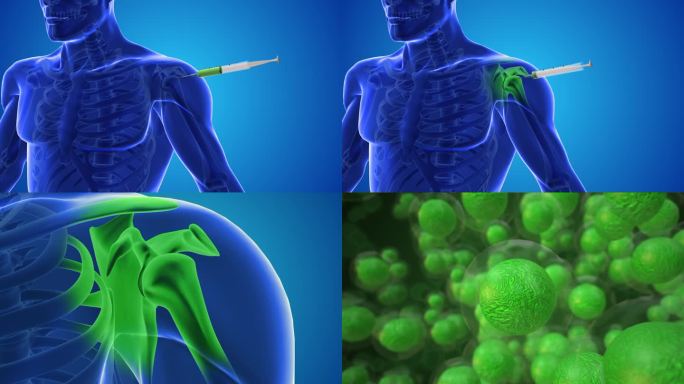一个动画显示干细胞被注射到人类的肩膀