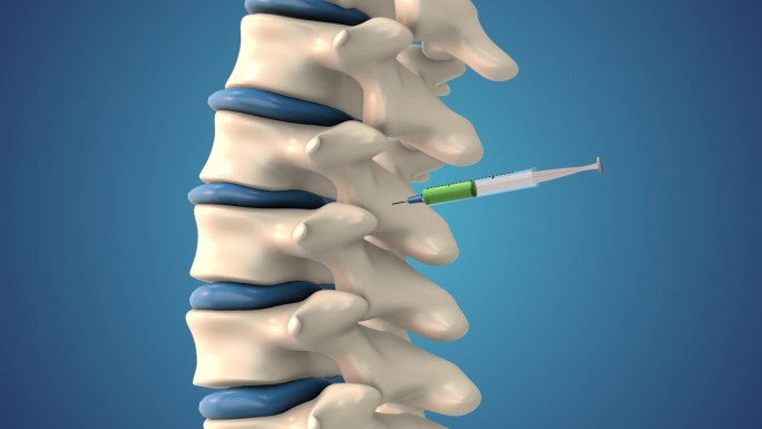 将干细胞注入人体脊柱