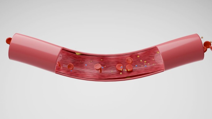 血管中的高胆固醇3D动画演示血管堵塞模拟
