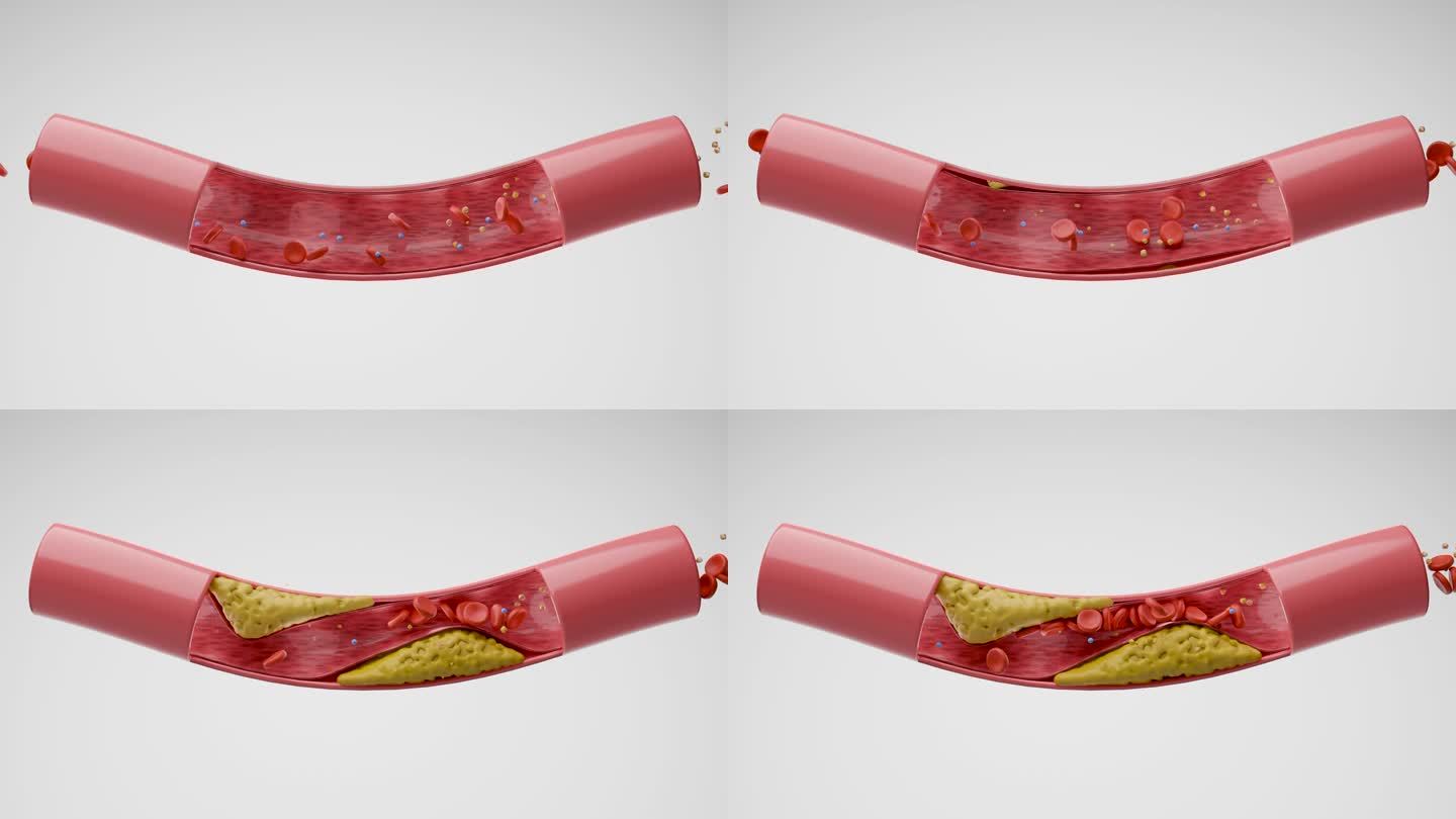 血管中的高胆固醇3D动画演示血管堵塞模拟
