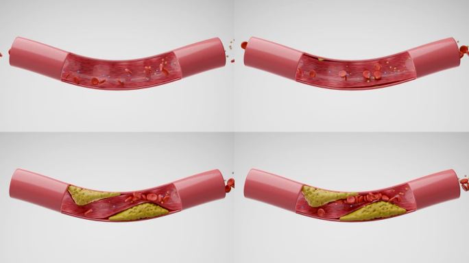 血管中的高胆固醇3D动画演示血管堵塞模拟