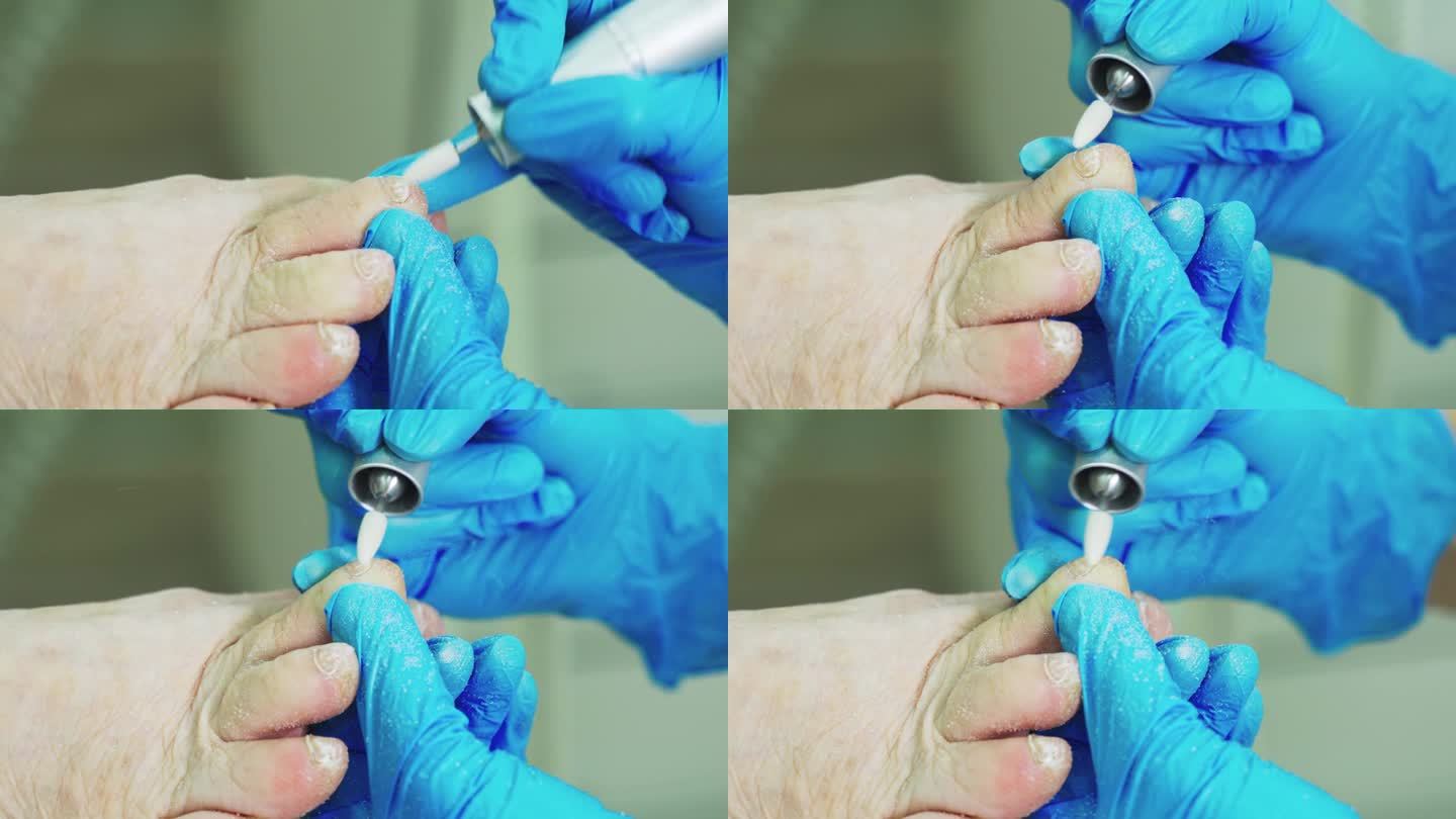 骨科医生治疗真菌感染的脚趾甲。