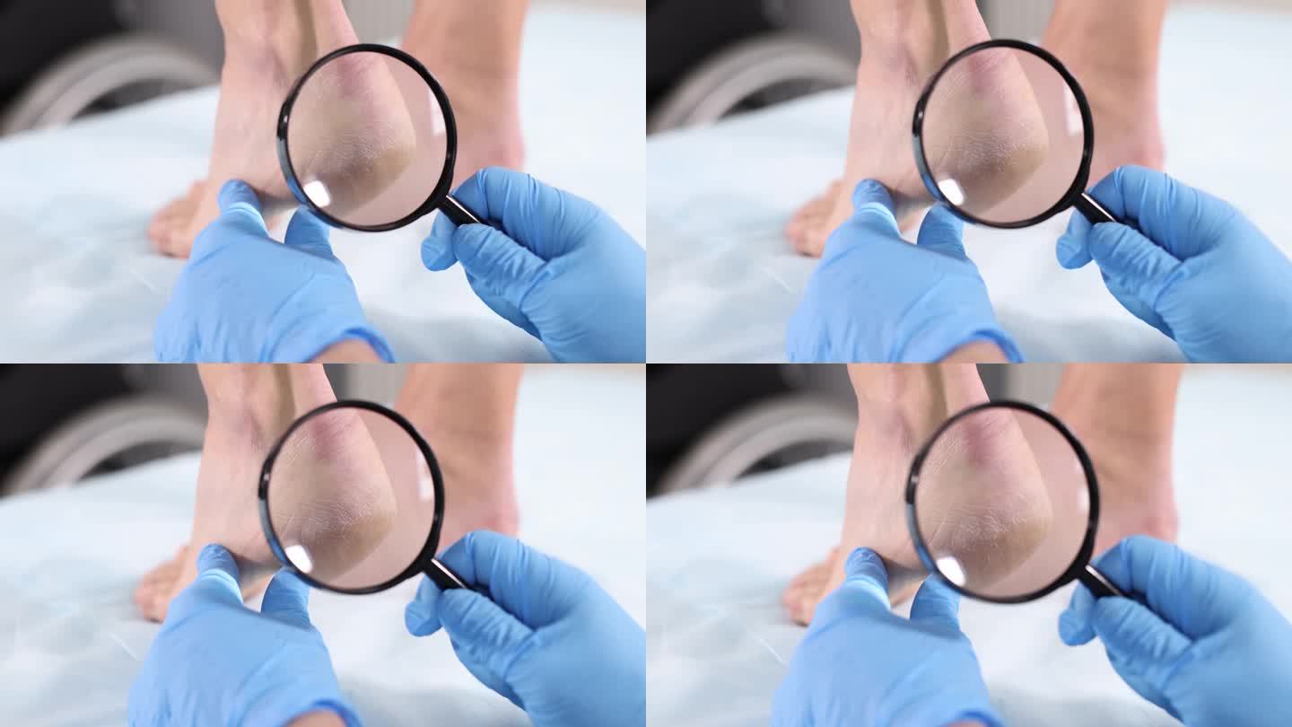 足病医生用放大镜4k电影检查病人脚跟的裂缝