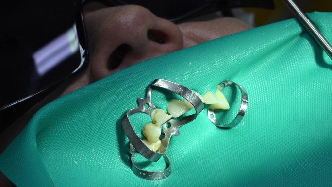 牙科极端近距离微距视频。牙医治疗病人的牙齿。正畸医生与助手使用围堰工作。专业口腔卫生理念。4k 12