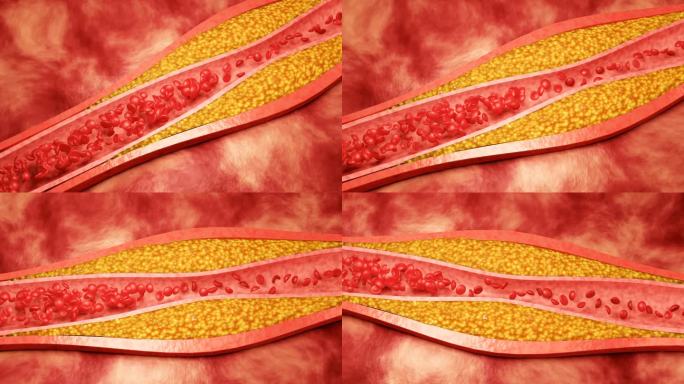 高脂血症。动脉阻塞的概念和人体血管作为一种疾病与胆固醇脂肪堆积堵塞。动脉阻塞，动脉中的胆固醇斑块。三