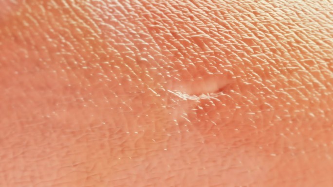 健康人体皮肤组织瘢痕再生-三维动画。治疗后概念。