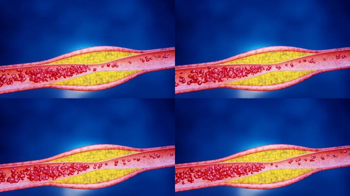 高脂血症。动脉阻塞的概念和人体血管作为一种疾病与胆固醇脂肪堆积堵塞。动脉阻塞，动脉中的胆固醇斑块。三