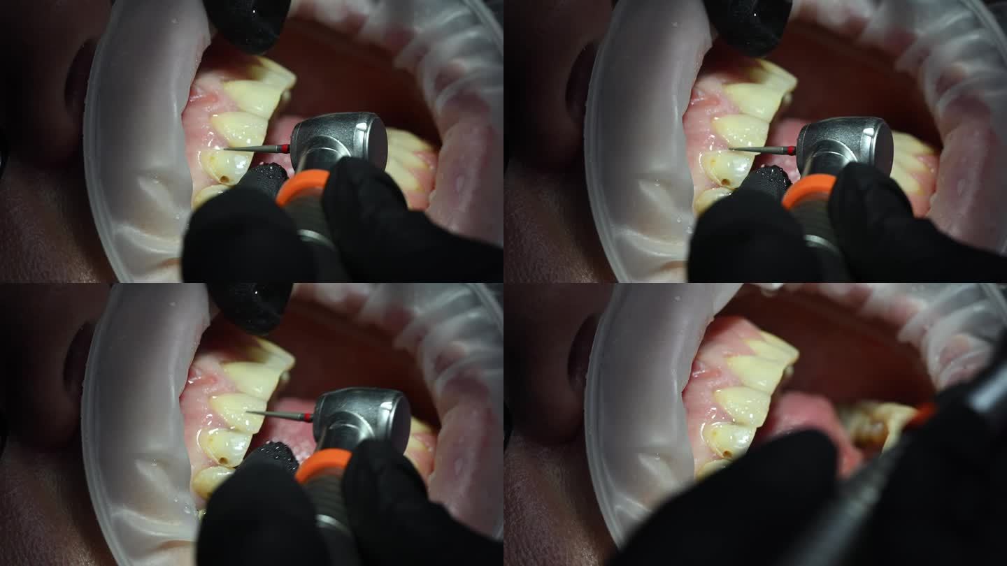 牙医治疗病人的牙齿。正畸医生与助手使用围堰工作。牙科极端近距离微距视频。专业口腔卫生理念。4k 12