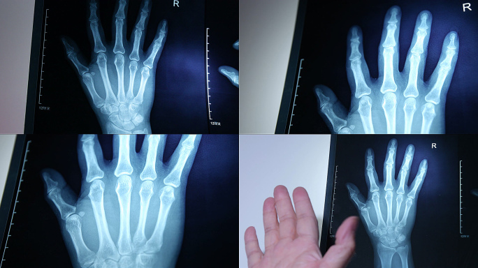 X光 人体骨骼 手部 ct 放射科 透视