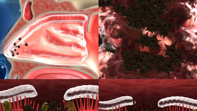 细菌感染鼻癣堆积鼻炎