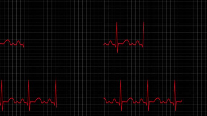 原创 心电图 心脏跳动