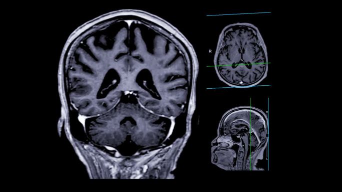 带参考线的MRI大脑可以帮助医生寻找出血、肿胀、肿瘤、感染、炎症、损伤或中风等疾病。
