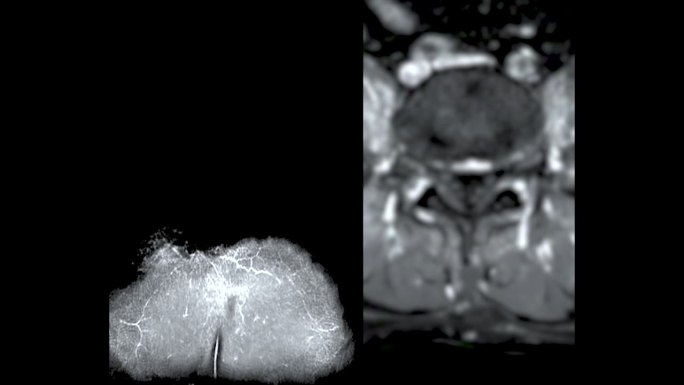 脊柱或腰椎MRI L-S诊断脊髓压迫。