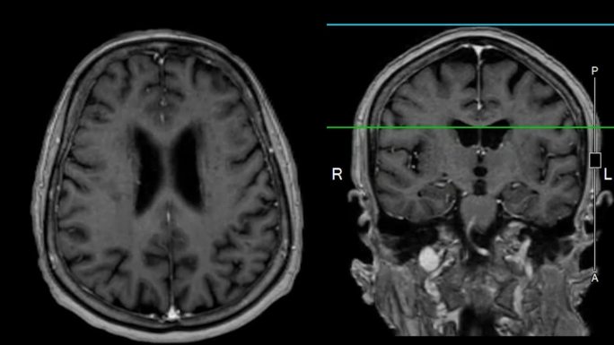 带参考线的MRI大脑可以帮助医生寻找出血、肿胀、肿瘤、感染、炎症、损伤或中风等疾病。