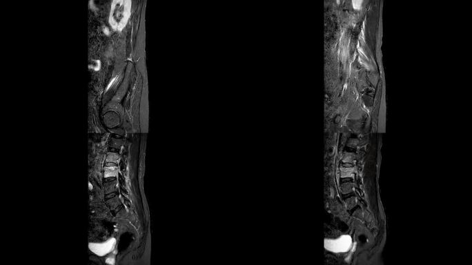 脊柱或腰椎MRI L-S诊断脊髓压迫。