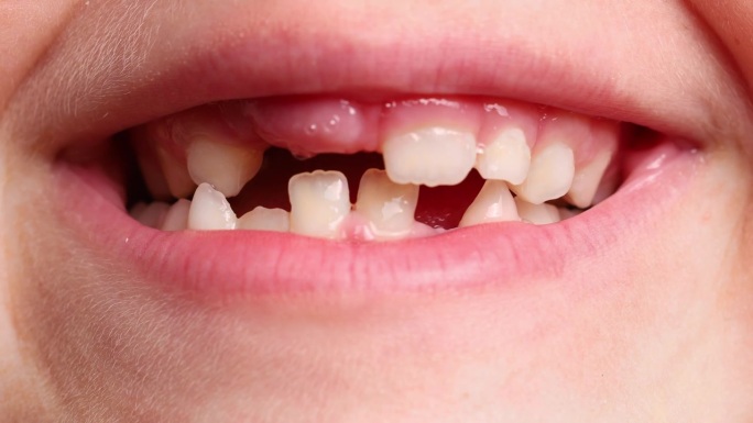 近距离视频的小孩子无牙的嘴显示牙齿和颌龈白色工作室的后景。牙科、口腔护理
