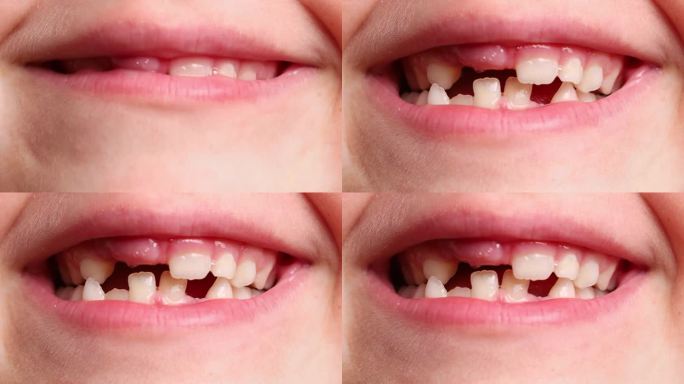 近距离视频的小孩子无牙的嘴显示牙齿和颌龈白色工作室的后景。牙科、口腔护理