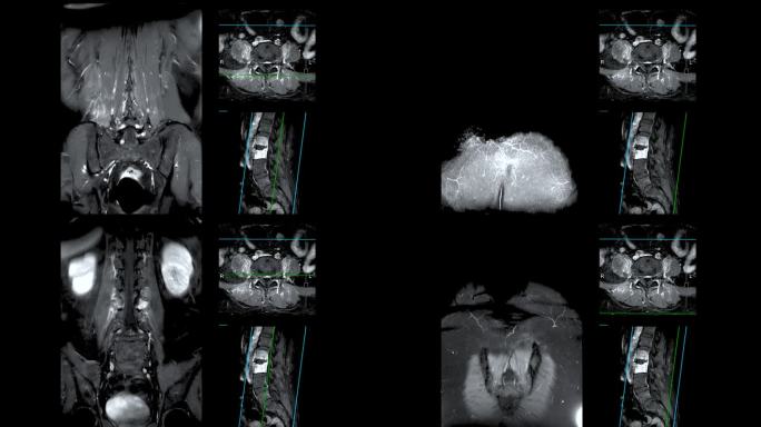 脊柱或腰椎MRI L-S显示脊柱结核。