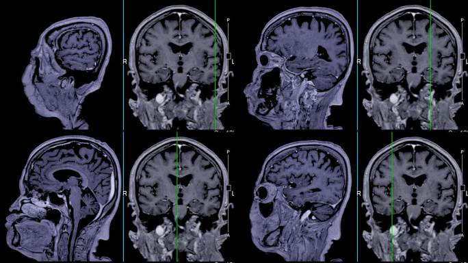 带参考线的MRI大脑可以帮助医生寻找出血、肿胀、肿瘤、感染、炎症、损伤或中风等疾病。