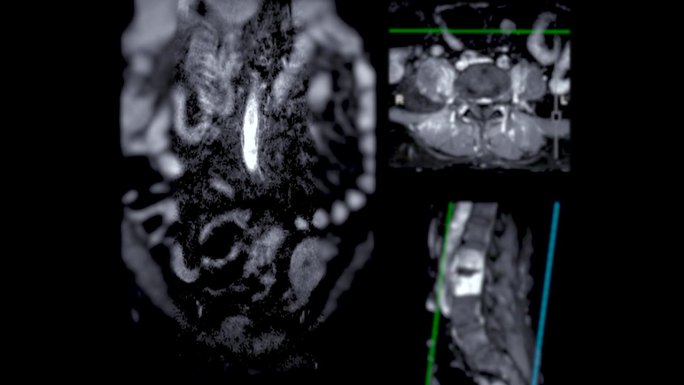 脊柱或腰椎MRI L-S显示脊柱结核。