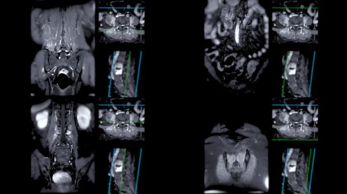 脊柱或腰椎MRI L-S显示脊柱结核。