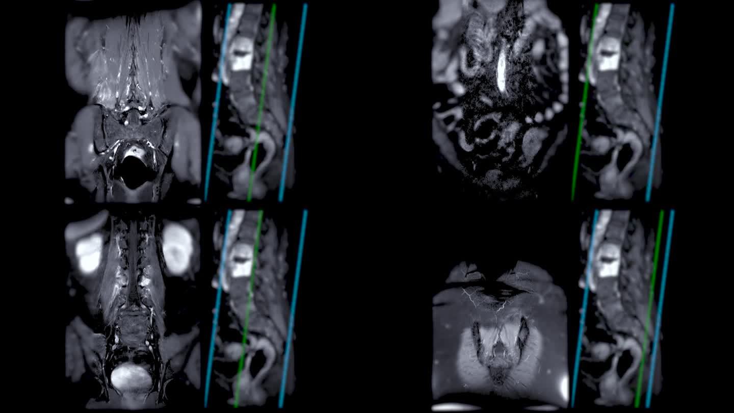 脊柱或腰椎MRI L-S显示脊柱结核。