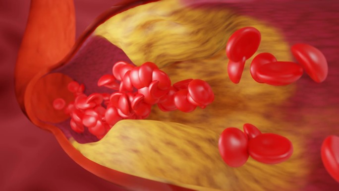 高脂血症。动脉阻塞的概念和人体血管作为一种疾病与胆固醇脂肪堆积堵塞。动脉阻塞，动脉中的胆固醇斑块。三