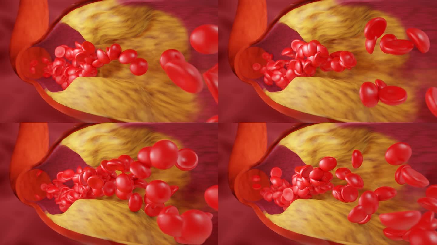 高脂血症。动脉阻塞的概念和人体血管作为一种疾病与胆固醇脂肪堆积堵塞。动脉阻塞，动脉中的胆固醇斑块。三