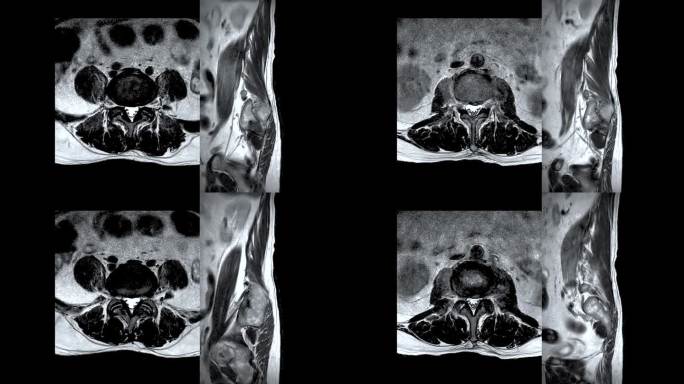 脊柱或腰椎MRI L-S诊断脊髓压迫。